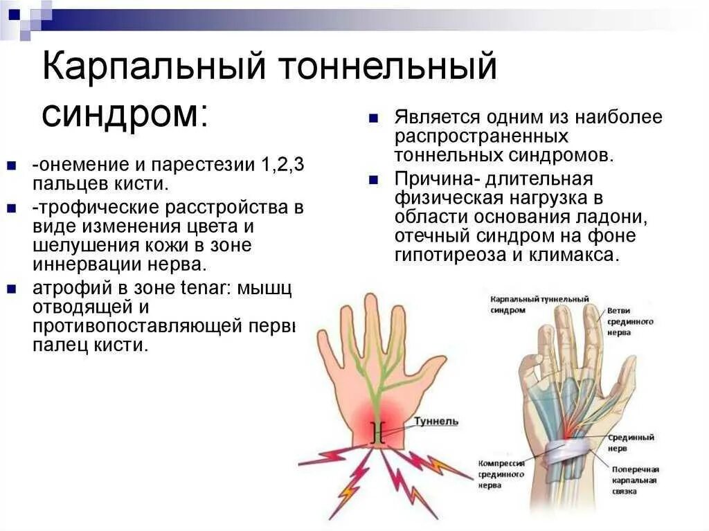 Как лечить запястный синдром. Карпальный туннельный синдром кисти. туннельный синдром лучезапястного сустава. карпальный синдром лучезапястного сустава. карпальный туннельный синдром запястья операция.