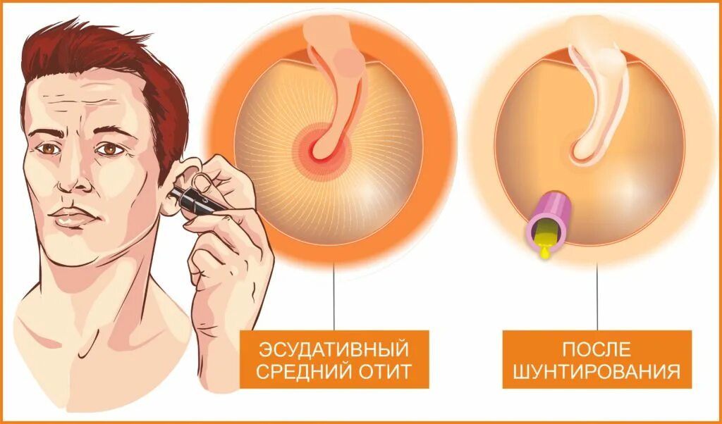 При высмаркивании заложило ухо что делать. Шунтирование барабанной перепонки. Шунт барабанной перепонки.