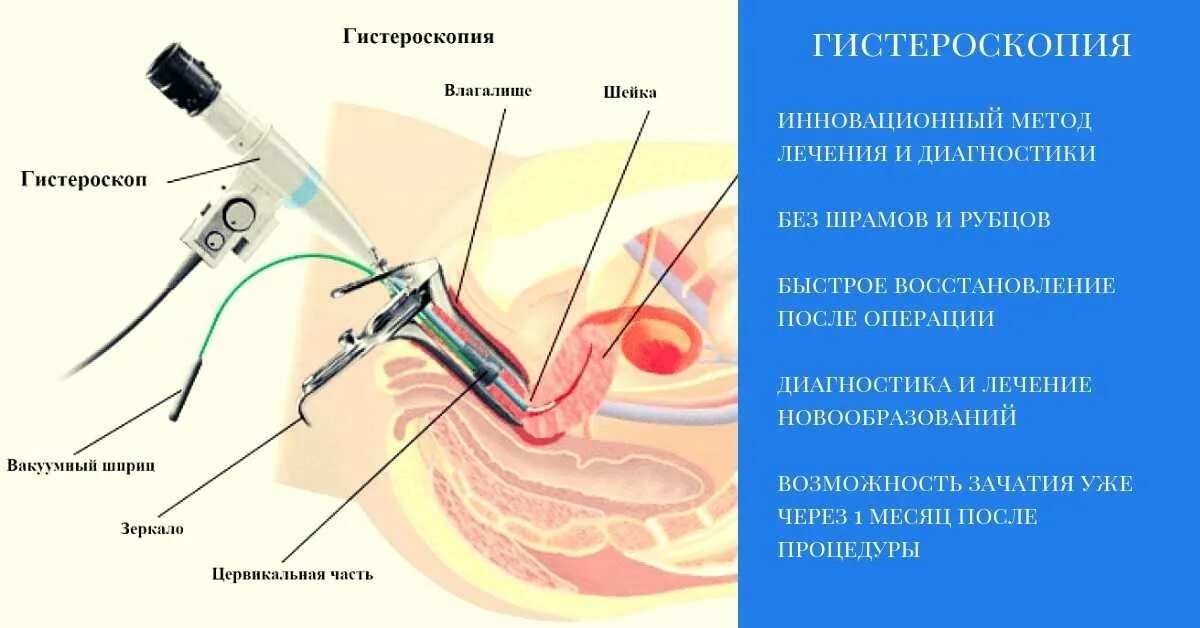 Операция полипы сколько стоит. Гистероскопия этапы операция. . Гистероскопия (субмукозные узлы).. Гистерорезектоскопия (резектоскопия). Гистероскопия полипов этапы.