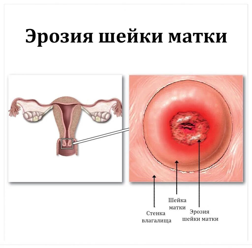 Влагалище Нерожавшей Женщины