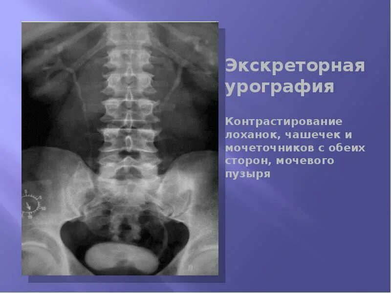 Рентгеноанатомия почек. Обзорная урография рентген. Экскреторная урография в норме рентген. Дополнительные методы рентгенологического исследования. Экскреторная урография методика.