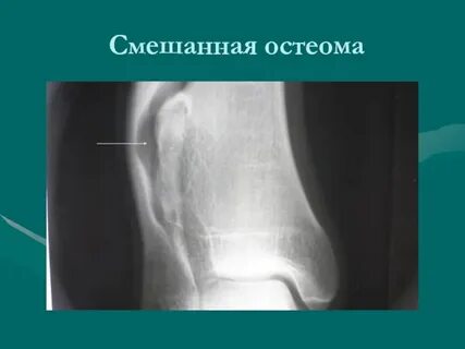 Костная опухоль