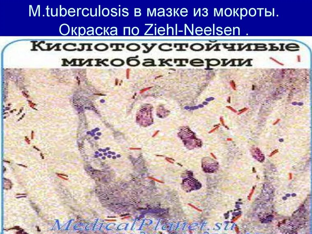 Кристаллы куршмана в мокроте. Кристаллы Шарко Лейдена. Кристаллы Шарко-Лейдена в мокроте. Кристаллы Шарко-Лейдена в Кале.