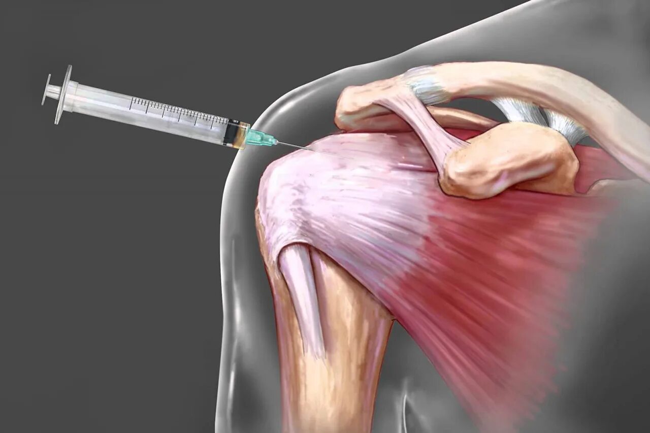 блокада сухожилия надостной мышцы. болит мышца после укола в ягодицу. мышцы для внутримышечной инъекции. болит мышца после укола. уколы и попадание в седалищный нерв в ягодице.