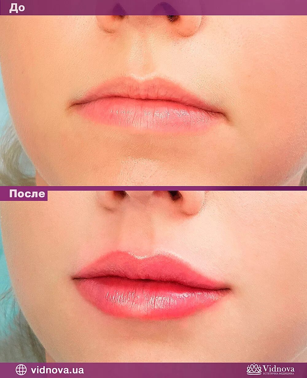 Губы после 1 ml гиалуроновой кислотой. Хейлопластика кессельринг. 1 мл до и после. Ювидерм ультра смайл 1 мл. 1 мл до и после.