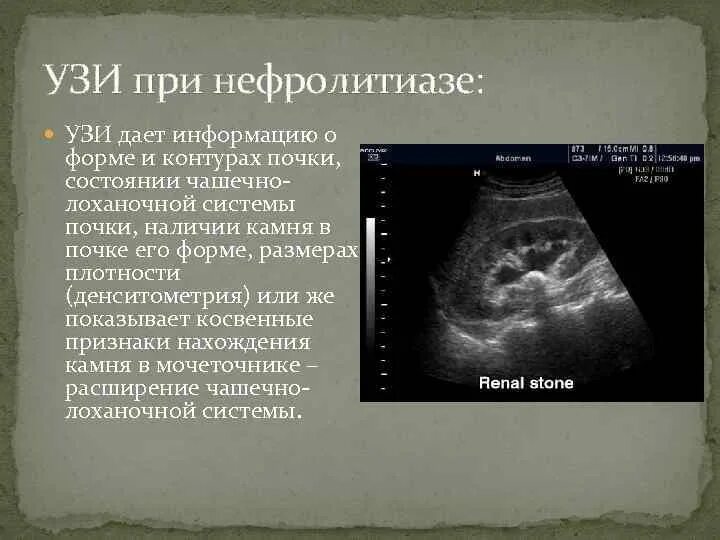 Как выглядят камни в почках на узи Неотложная урология