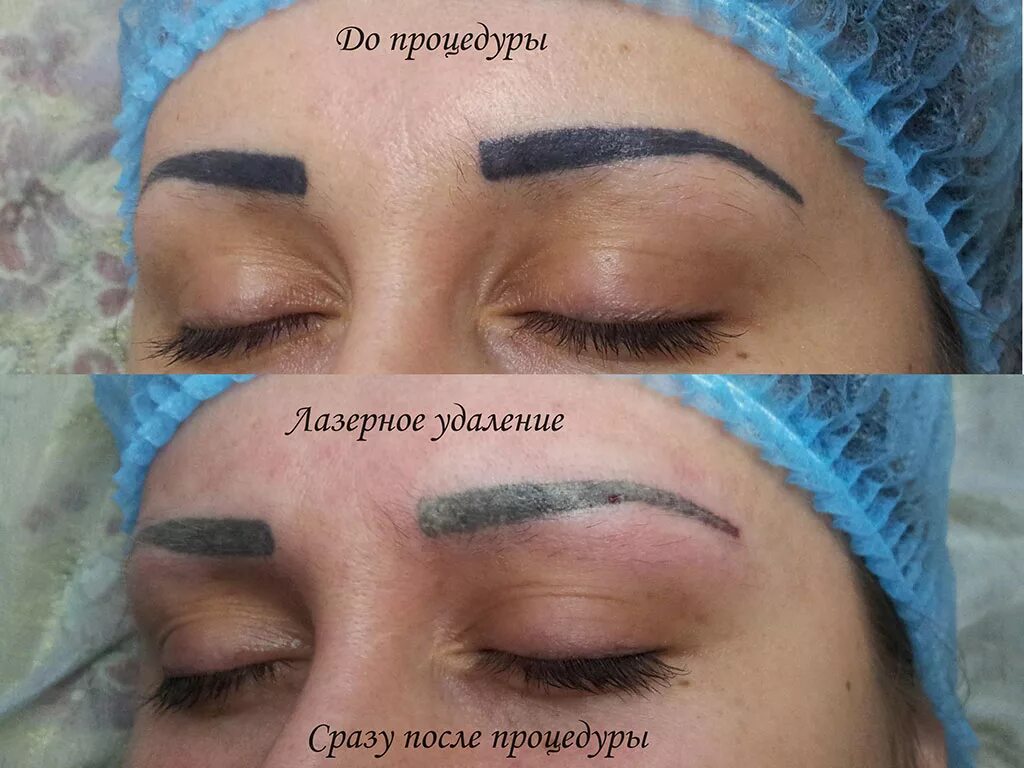 ремувер для татуажа. брови после удаления татуажа лазером отзывы. фото бровей после лазерного удаления. снятие татуажа бровей. лазерное выведение татуажа бровей.