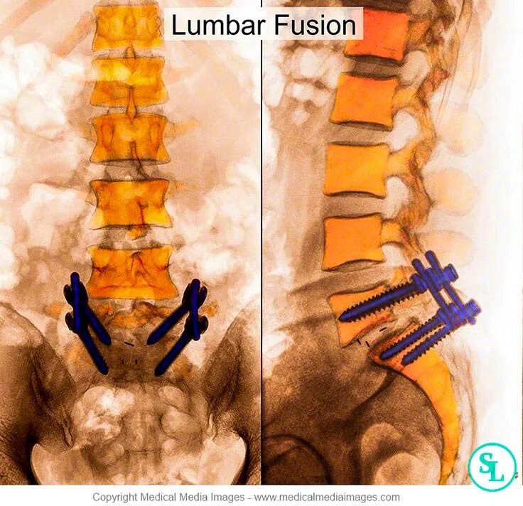 Операция спондилолистез поясничного. Спондилолистез пояснично-крестцового. Спондилолистез пояснично-крестцового отдела позвоночника операция. Передний спондилодез поясничного отдела позвоночника. Операции на поясничном отделе позвоночника с металлоконструкцией