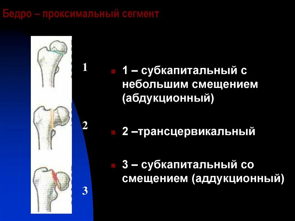 Классификация переломов шейки бедренной кости. Субкапитальный перелом бедренной кости. Классификация переломов бедренной кости. Субкапитальный отдел бедренной кости.