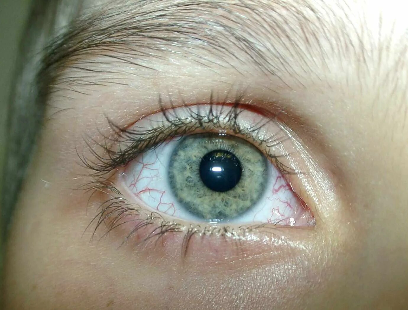 Старческая дуга аркус сенилис. Желтизна на белках глаз. Иктеричяностьс склрел. Здоровые глаза. Гипосфагма гифема гемофтальм.