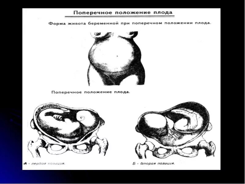 Поперечное плода при беременности. Поперечное положение предлежание плода. Предлежание при поперечном положении плода. Поперечно овальная форма живота. Позиция плода при поперечном положении