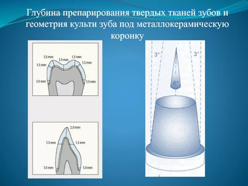 Препарирование под металлическую коронку. Препарирование зуба под коронку. схема препарирования под коронку. литая коронка препарирование. отпрепарированный премоляр под металлокерамическую коронку.