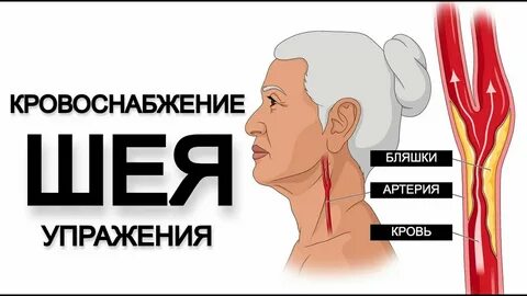 Шейный инсульт