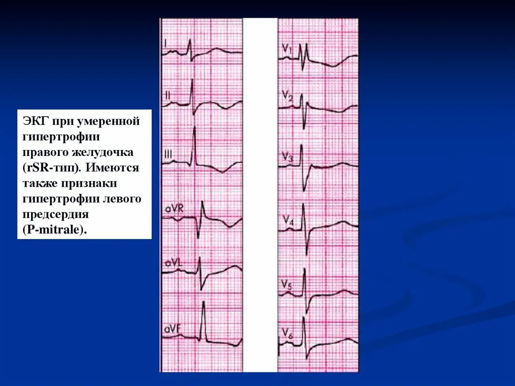 Гипертрофия левого и правого желудочка на ЭКГ. ЭКГ-изменения при гипертрофиях миокарда.. ЭКГ при гипертрофии левого правого желудочка. ЭКГ правый гипертрофия правый желудочек. Гипертрофия левого предсердия левого желудочка