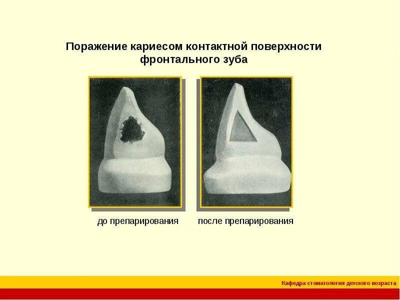 Препарирование зуба по блэку. Препарирование контактной поверхности. препарирование изображения. классификация по блеку кариеса.