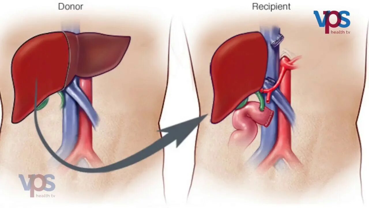 Пересадка от живого донора. Трансплантация печени. Ортотопическая трансплантация печени. Операция по трансплантации печени. Донор пересадки печень.