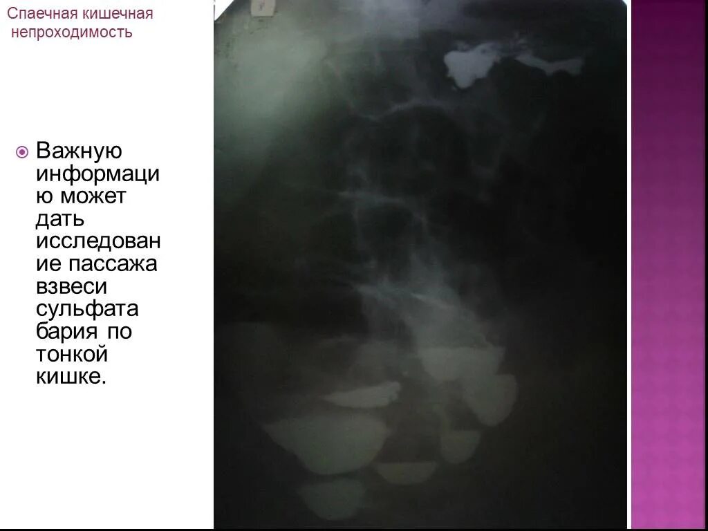Пассаж кишечника. Кишечная непроходимость ирригоскопия. толстокишечная непроходимость пассаж бария. пассаж бария по кишечнику рентген.