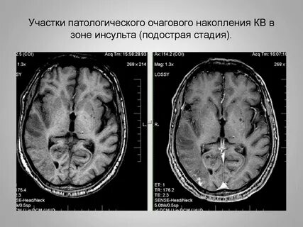Стадии ишемического инсульта