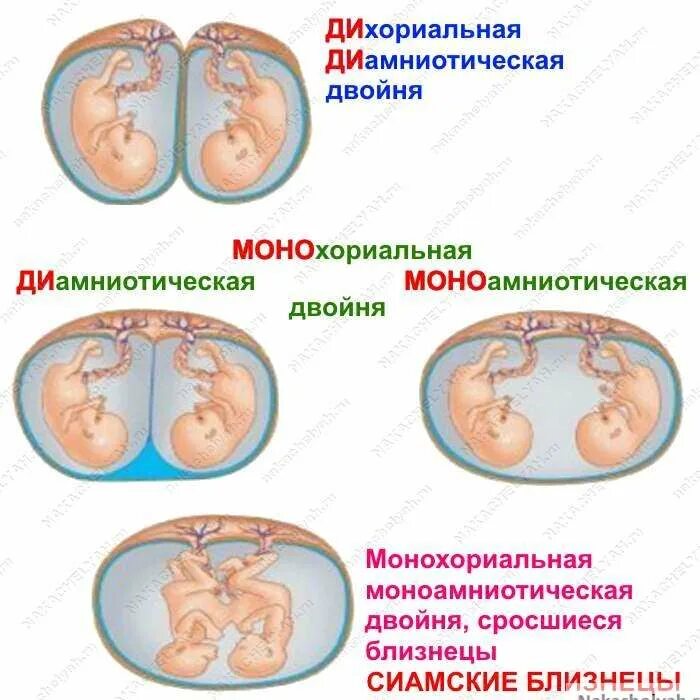 Двойная ди ди. Монохориальная бихориальная двойня. Монохориальная моноамниотическая многоплодная беременность. Монохориальная моноамниотическая двойня беременность. Многоплодная беременность дихориальная диамниотическая.