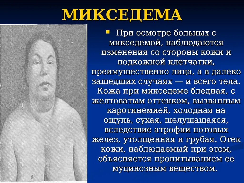 При микседеме наблюдается.