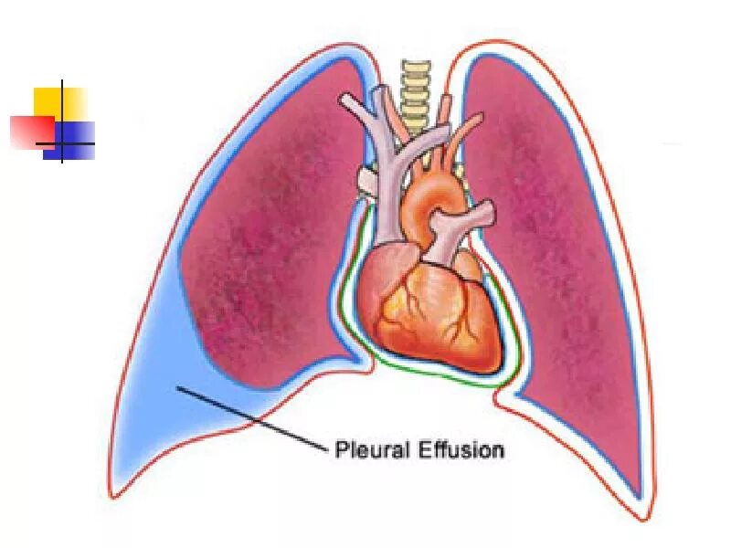 Серозный плевральный экссудат. Серозный экссудат плевральной жидкости. Плевральные осложнения