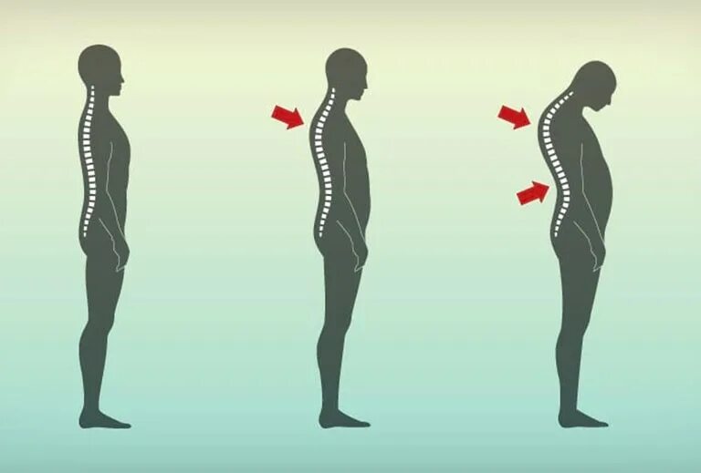Кифоз грудного отдела позвоночника. Кифоз шейно грудного отдела. Кифоз лордоз сколиоз грудного отдела позвоночника. Искривление позвоночника сутулость.