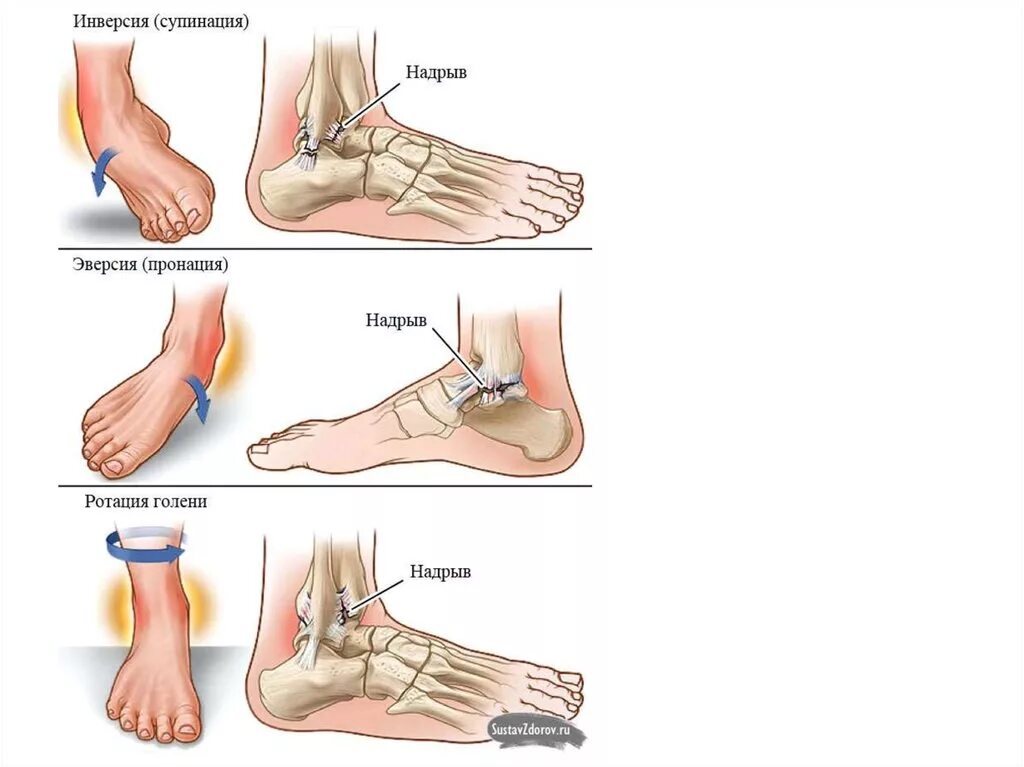 Перелом голеностопного сустава. Пронация и супинация стопы. Супинация и пронация голеностопного сустава. Ротация супинация пронация. Эверсия инверсия пронация супинация.