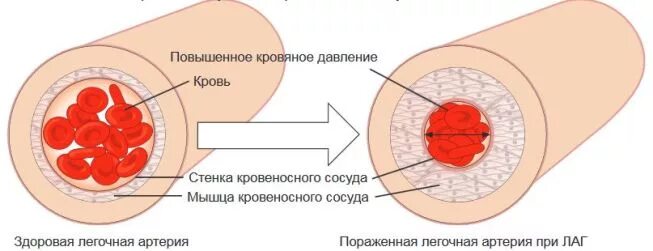 Расширение стенок сосудов. Изменение стенки сосуда при артериальной гипертензии. Изменения сосудистой стенки при артериальной гипертензии. Схема изменений сосудистой стенки при гипертонической болезни. Сосуды при артериальной гипертензии.