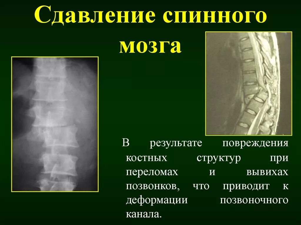Сдавление спинного мозга. Перелом позвоночника с повреждением спинного мозга. Травмы позвоночника с повреждением спинного мозга.