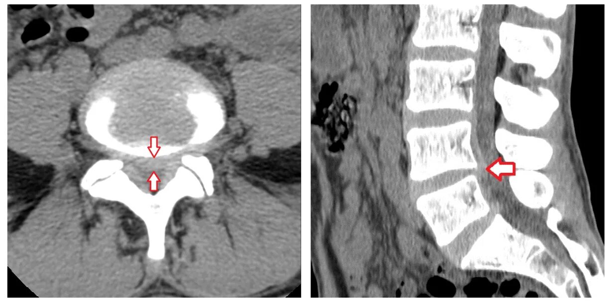 Медианно парамедианная билатеральная. Кт протрузии межпозвонковых дисков. Грыжи и протрузии позвоночника кт. Протрузия межпозвонковых дисков кт. Протрузия межпозвонкового диска кт.