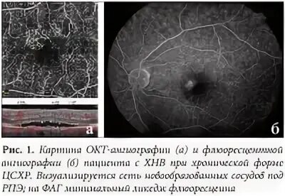 Ангио окт. Окт ангиография сетчатки. окт макулы ангиография что это. оптическая когерентная томография ангиография. оптическая когерентная томография сетчатки ангио.