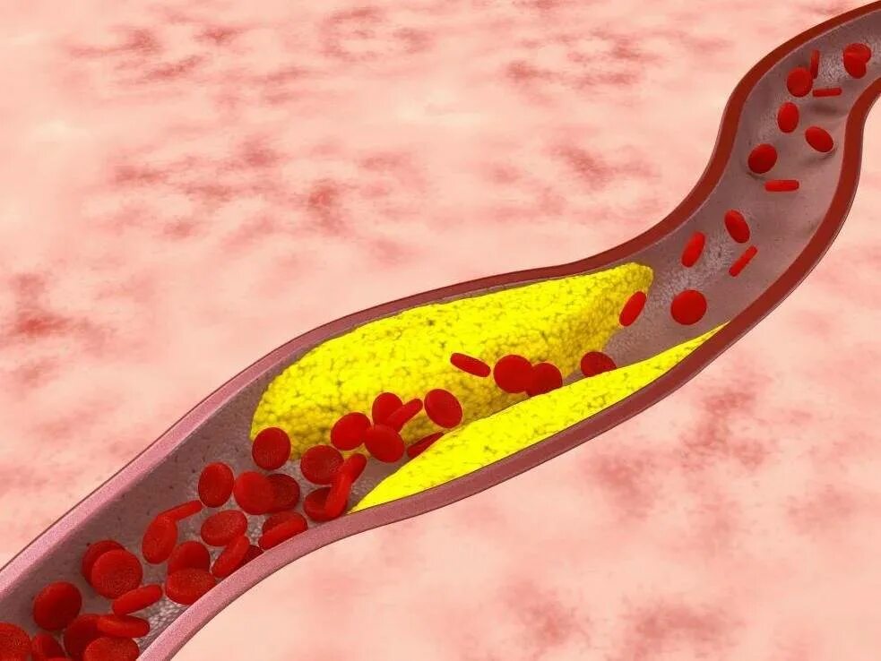 Как очистить сосуды от холестериновых тромбов