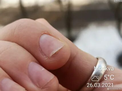 Бальзам регенерирующий для ногтей стоп онихолизис