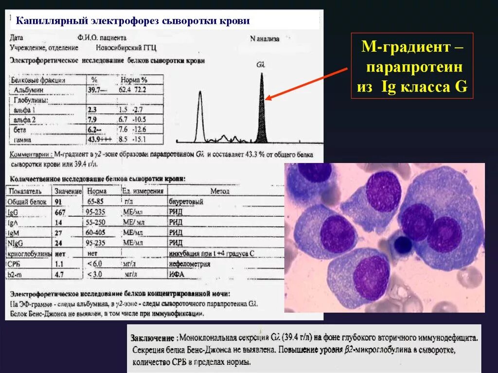 М градиент сыворотки крови 13 г/л при миеломе. М градиент сыворотки крови что это такое. Исследование парапротеинов в крови. Электрофорез сыворотки крови.