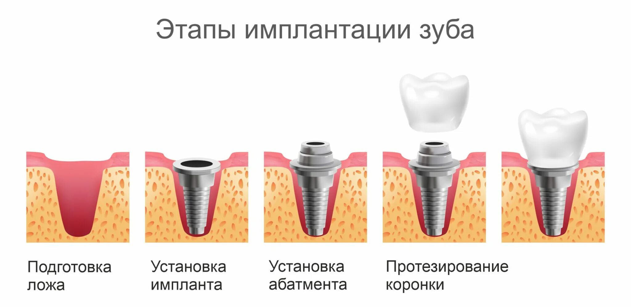Процесс установки импланта. Процесс установки импланта