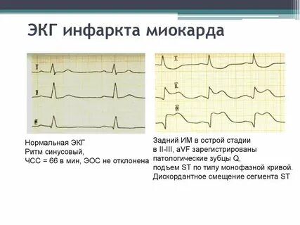 Экг больного с инфарктом миокарда