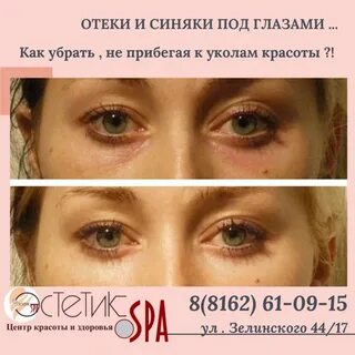 Как сделать чтобы не было синяка