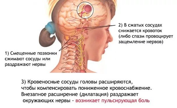 Может от. Ущемление затылочного нерва. Сосуды затылочной части головы. Болит голова при шейном остеохондрозе.