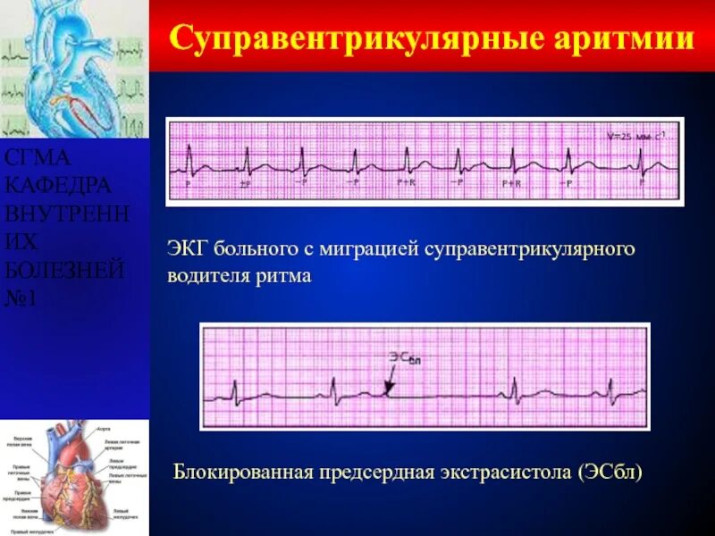 Блокированные предсердные экстрасистолы на ЭКГ. Нижнепредсердный ритм на ЭКГ. Блокированная суправентрикулярная экстрасистолия ЭКГ. ЭКГ при нижнепредсердном ритме. Эктопический предсердный ритм что это