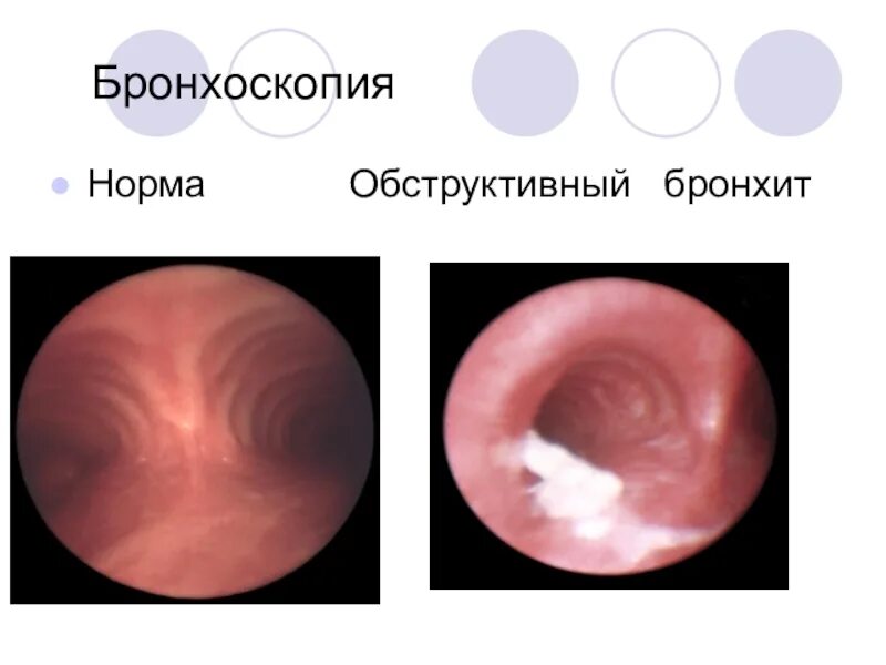 Бронхоскопия мокроты. Фибробронхоскопия туберкулеза бронхов. Катарально Гнойный эндобронхит. Обструктивный бронхит бронхоскопия. Бронхоскопия при хроническом бронхите.