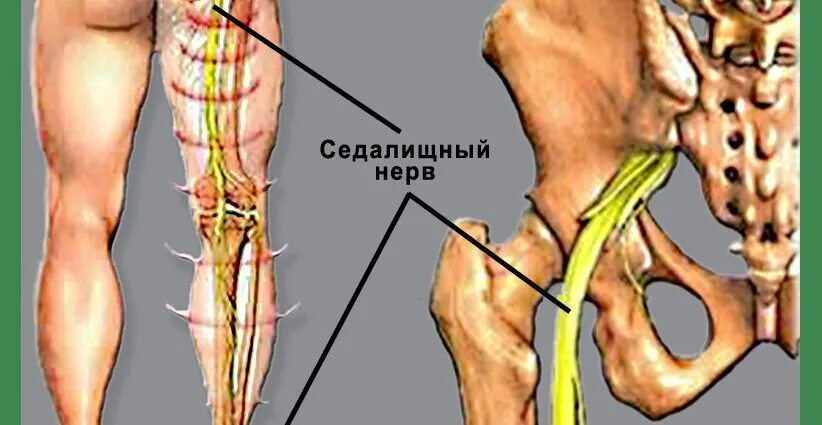 Ишиас воспаление седалищного нерва. Седалищный нерв грыжа позвоночника. Неврит седалищного нерва. Седалищный нерв Нейродикловит. Воспаление седалищного нерва симптомы у мужчин