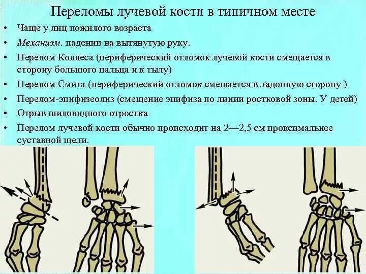 Смещение кости на руке без перелома. Смещение отломков при переломе Смита. Рентген лучезапястный сустав перелом лучевой кости. Перелом луча в типичном месте. Типы переломов лучевой кости в типичном месте.