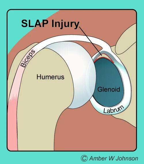 Слэп синдром плечевого сустава. Slap повреждение плечевого. Повреждения суставной губы плечевого сустава slap. Классификация slap повреждения.