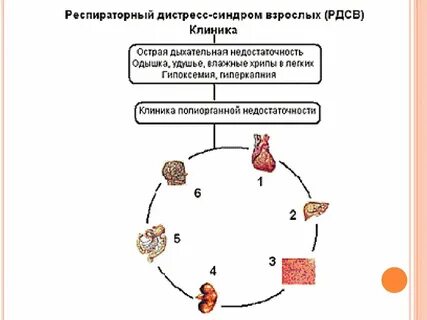 Острый дистресс