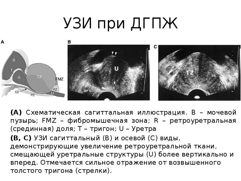 Диффузное изменение мочевого пузыря