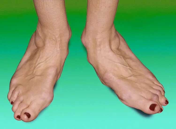 Подагра голеностопного сустава. Ногоболт. Тофусы деформирующий артроз. Болезнь суставов ног. Теедит ахиллова сухожилия.