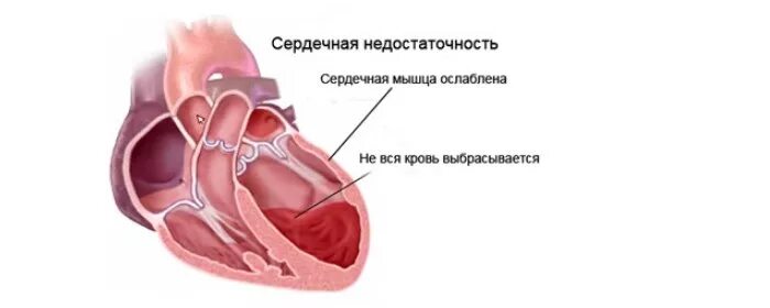 Поражение сердца с застойной сердечной недостаточностью. Левожелудочковая сердечная недостаточность застой крови?. правосторонняя сердечная недостаточность. сердце при застойной недостаточности.