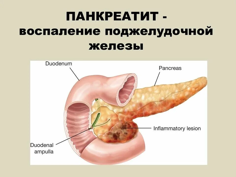 Нужна ли поджелудочная. Панкреатин поджелудочная железа. Лекарства воспаление поджелудочной железы панкреатит. Воспалена поджелудочная железа. Что такое панкреатит поджелудочной.