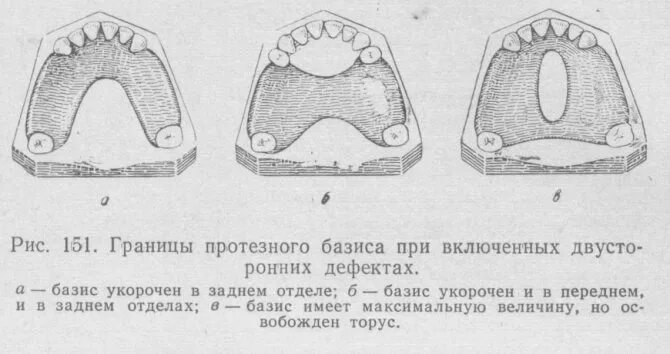 Границы пластиночного протеза. Классификация дефектов по Кеннеди и Гаврилову. Классификация дефектов зубных рядов по Кеннеди. Классификация зубных дефектов по Кеннеди с ПОДКЛАССАМИ. Классификация отсутствия зубов по Кеннеди.