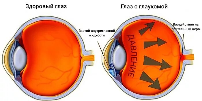 Давящие боли в области глаза. Глаукома глаза симптомы.